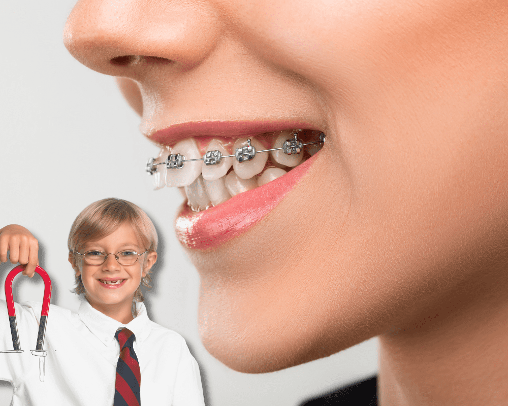 are braces magnetic
