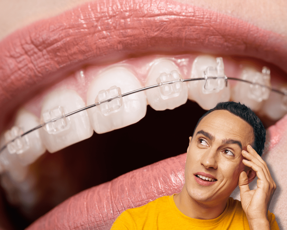 what are braces wire made of